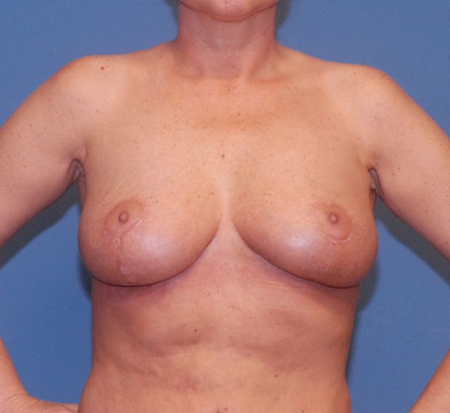 Breast Corrections And Revisions Before & After