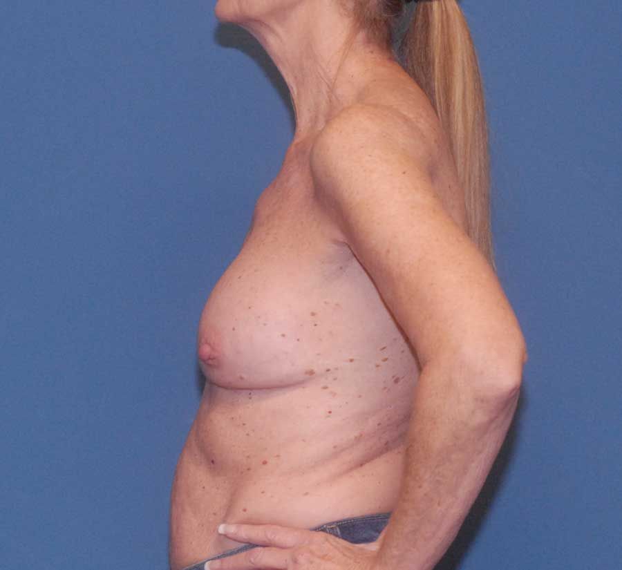 Breast Corrections And Revisions Before & After