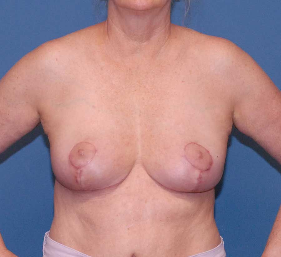 Breast Corrections And Revisions Before & After
