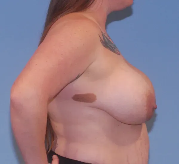 Breast Corrections And Revisions Before & After