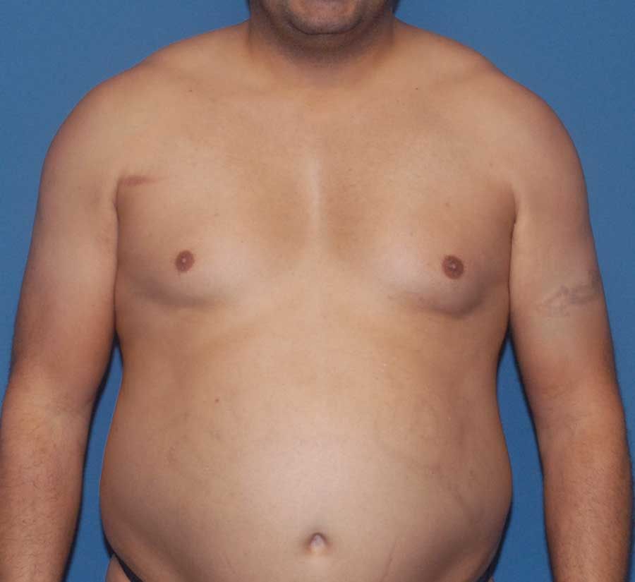 Gynecomastia Before & After