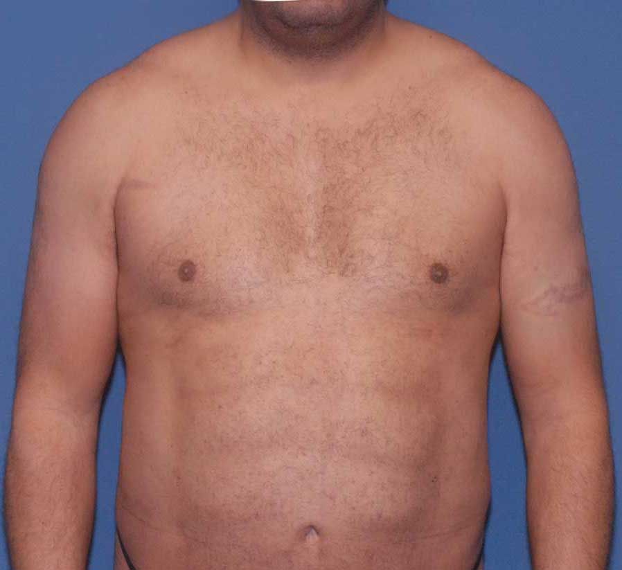 Gynecomastia Before & After
