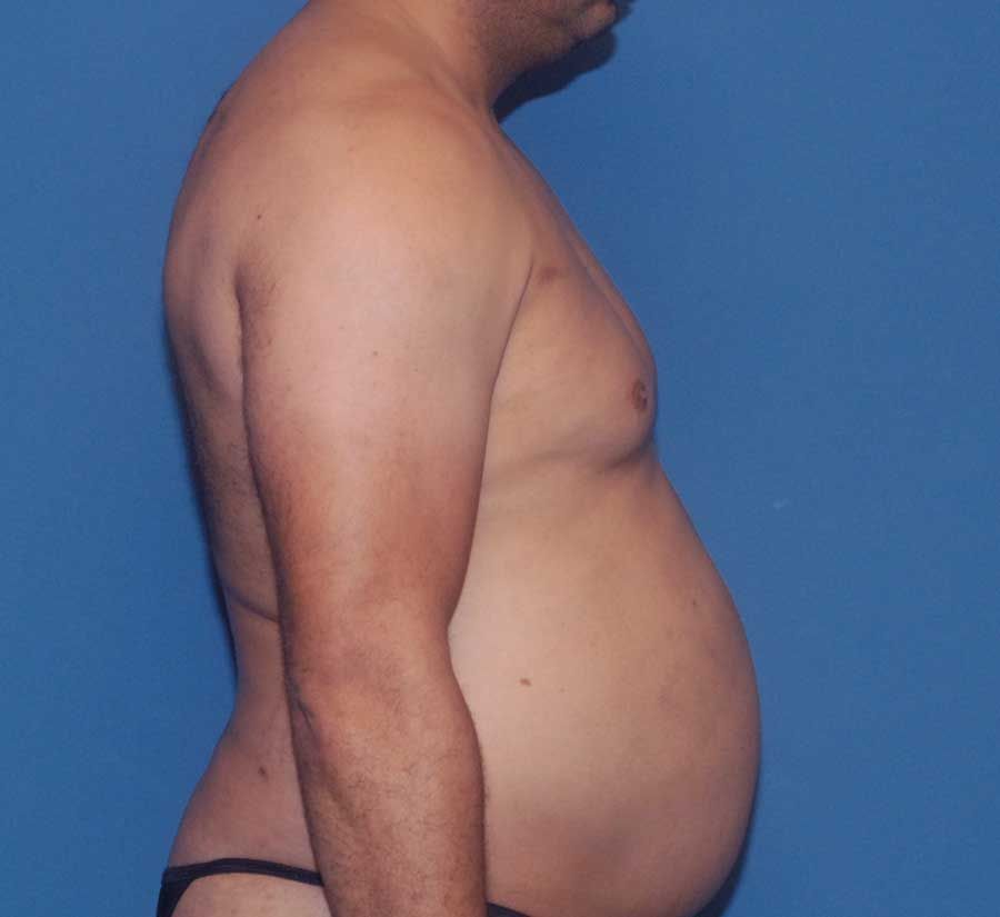 Gynecomastia Before & After
