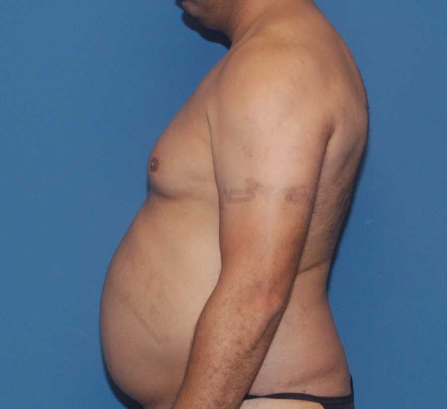 Gynecomastia Before & After