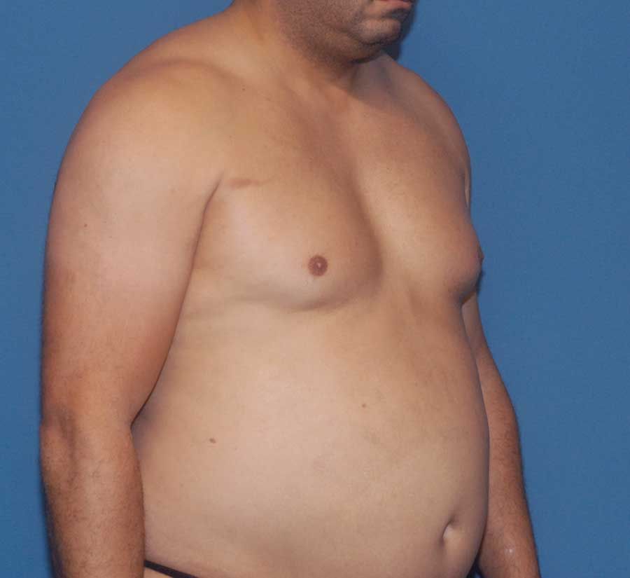 Gynecomastia Before & After