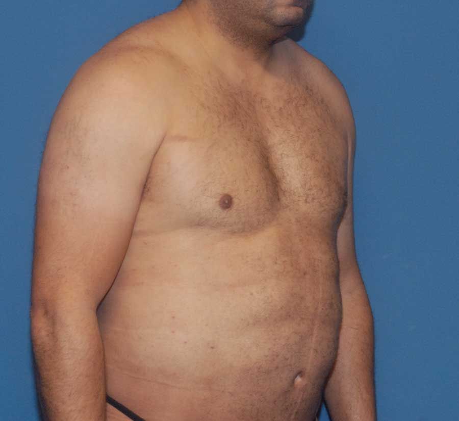 Gynecomastia Before & After