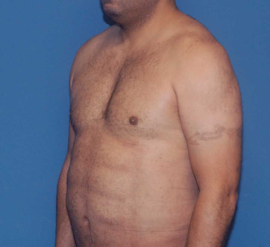 Gynecomastia Before & After