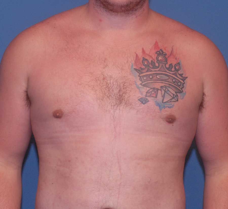 Gynecomastia Before & After