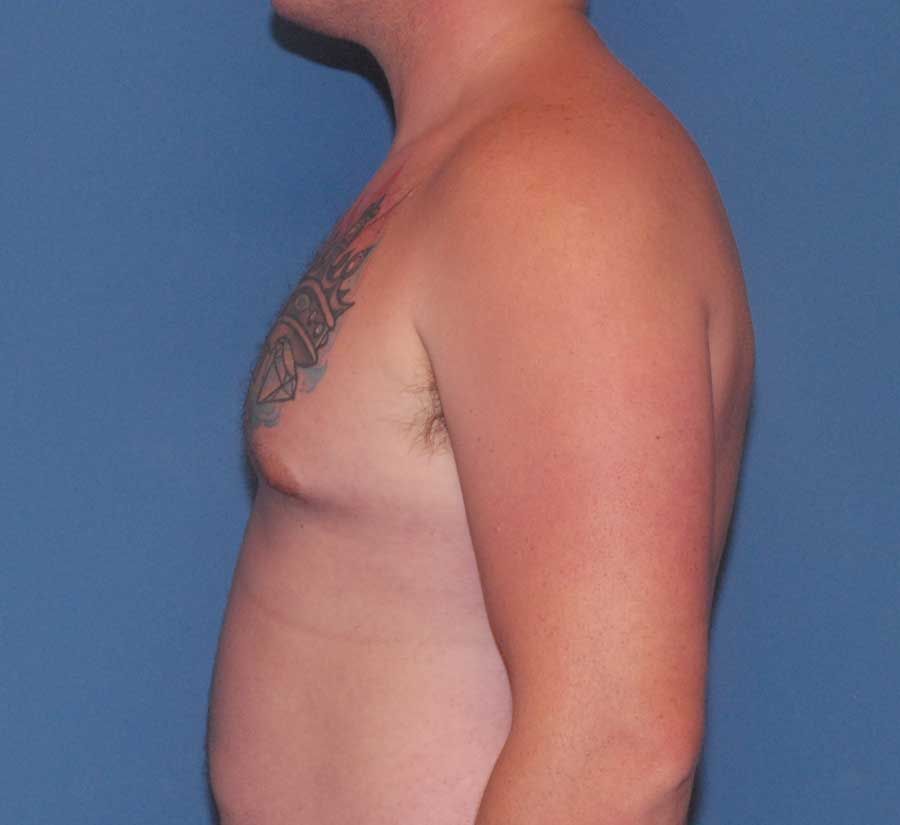 Gynecomastia Before & After