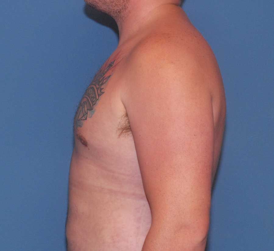 Gynecomastia Before & After
