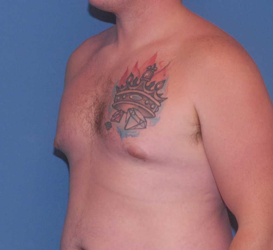 Gynecomastia Before & After