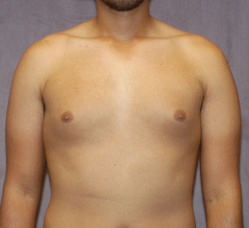 Gynecomastia Before & After