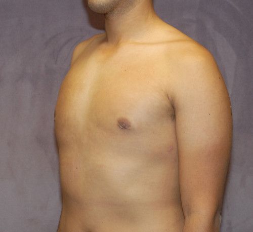 Gynecomastia Before & After