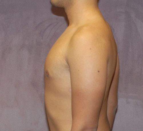 Gynecomastia Before & After