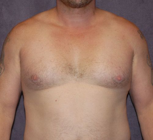 Gynecomastia Before & After