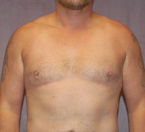 Gynecomastia Before & After
