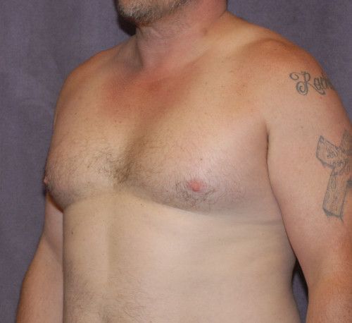 Gynecomastia Before & After