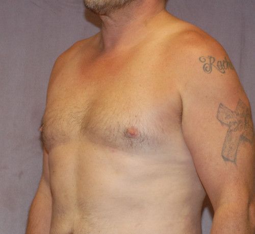 Gynecomastia Before & After