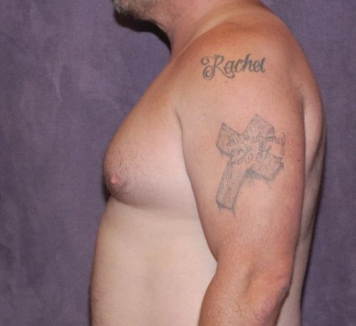 Gynecomastia Before & After