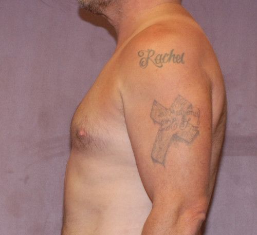 Gynecomastia Before & After