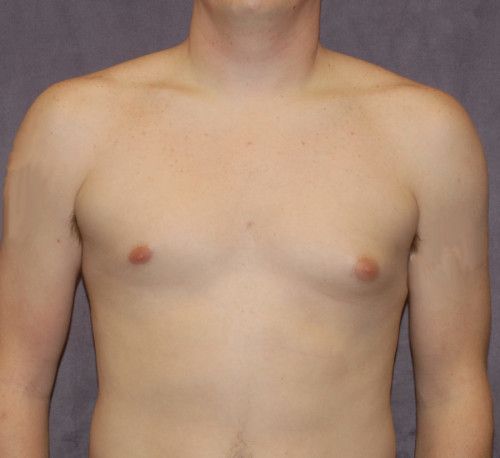 Gynecomastia Before & After
