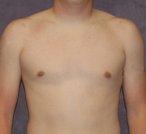Gynecomastia Before & After