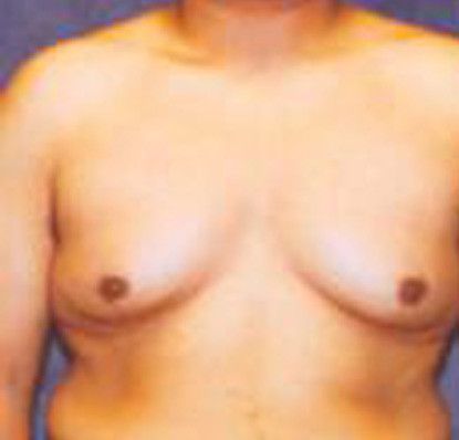 Gynecomastia Before & After