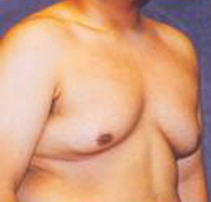 Gynecomastia Before & After