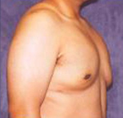 Gynecomastia Before & After