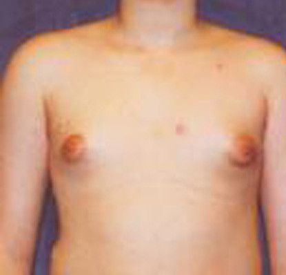 Gynecomastia Before & After