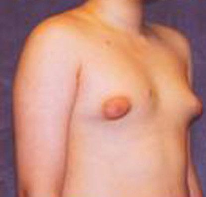 Gynecomastia Before & After