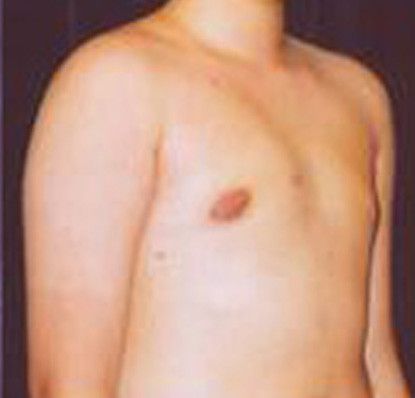 Gynecomastia Before & After