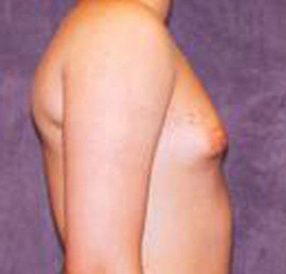 Gynecomastia Before & After