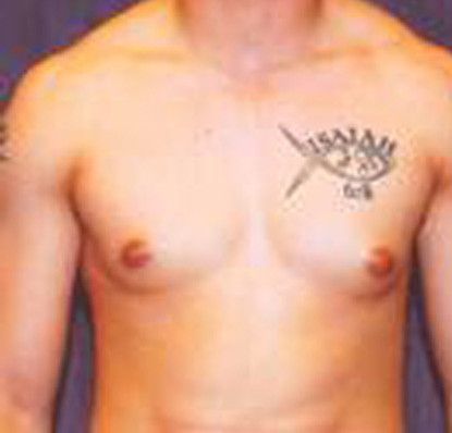 Gynecomastia Before & After