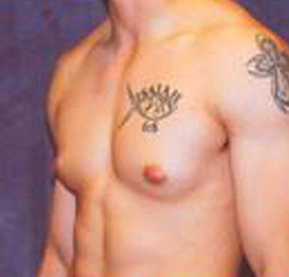 Gynecomastia Before & After