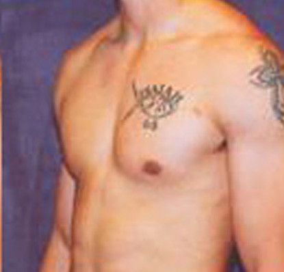 Gynecomastia Before & After