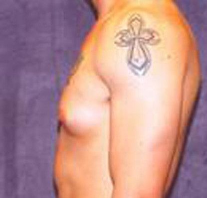 Gynecomastia Before & After