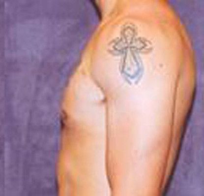 Gynecomastia Before & After