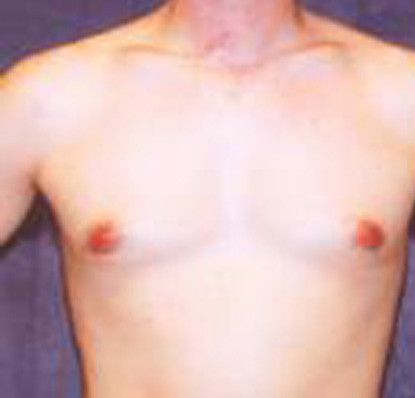Gynecomastia Before & After