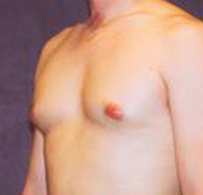 Gynecomastia Before & After