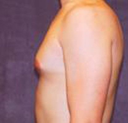 Gynecomastia Before & After