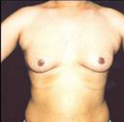 Gynecomastia Before & After