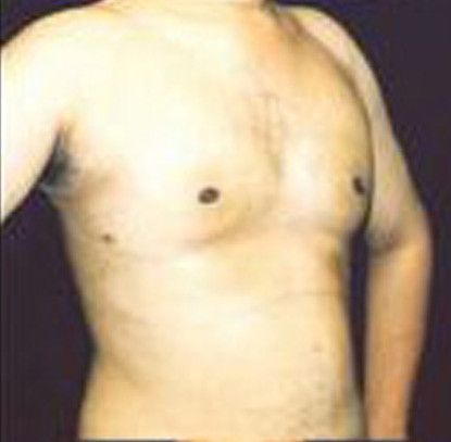 Gynecomastia Before & After