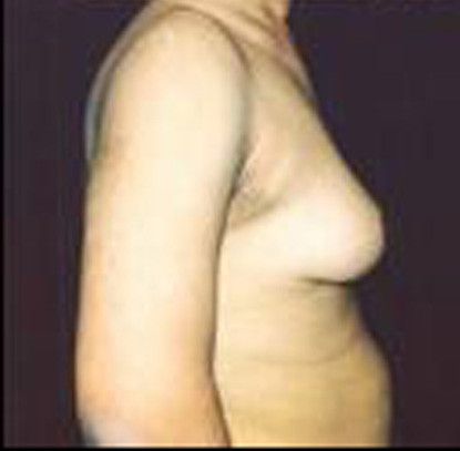 Gynecomastia Before & After