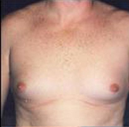 Gynecomastia Before & After