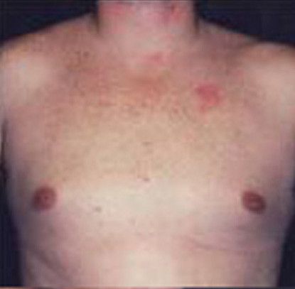 Gynecomastia Before & After