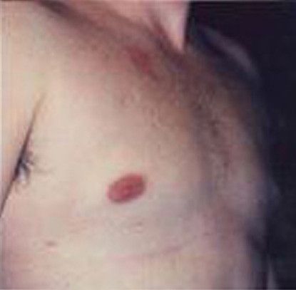 Gynecomastia Before & After