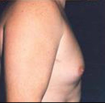 Gynecomastia Before & After