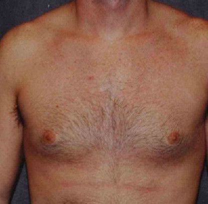 Gynecomastia Before & After