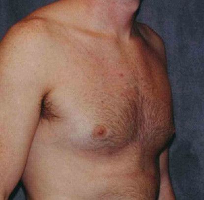Gynecomastia Before & After